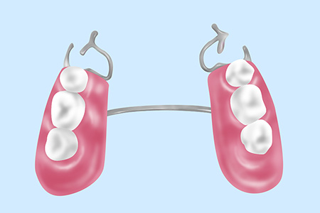 部分入れ歯