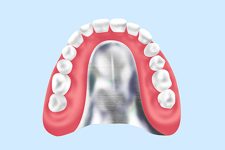 金属床義歯